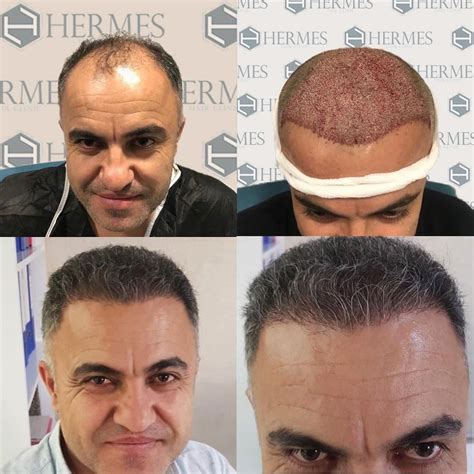 hermes hair clinic saç ekimi merkezi|saç ekimi istanbul.